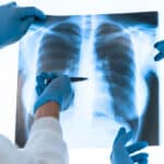 Pulmonary Fibrosis (PF) adalah Ancaman Utama Sistem Pernafasan