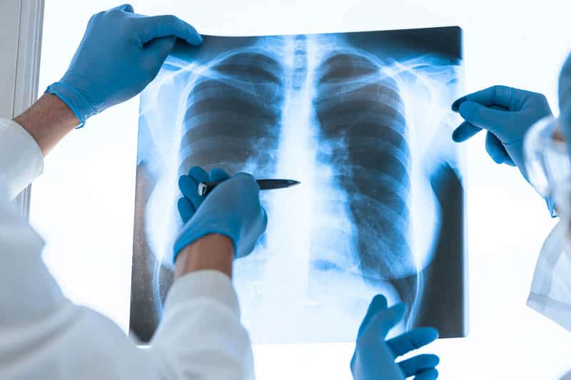 Pulmonary Fibrosis (PF) adalah Ancaman Utama Sistem Pernafasan