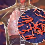 Bahayanya Tuberkulosis (TB)