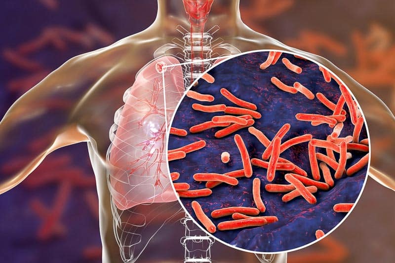 Bahayanya Tuberkulosis (TB)